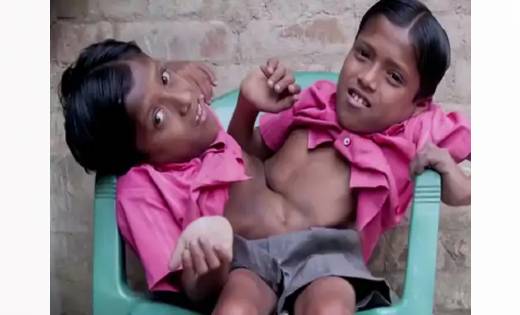 2 सिर 4 हाथ वाले जुड़वा भाइयों ने मौत से पहले बनाया था विडिय... - CG Sandesh