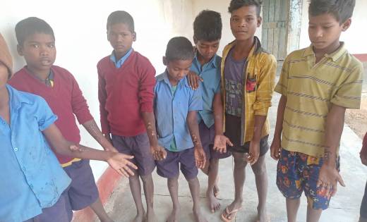 जहरीले वनस्पति के चपेट में आये हॉस्टल के बच्चे, हॉस्टल अधीक्... - CG Sandesh