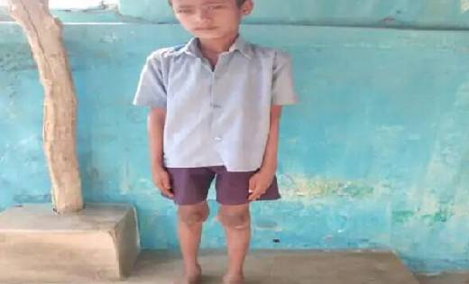 शिक्षिका ने छात्र को जलती माचिस की तीली से दागा, BEO ने थमाय... - CG Sandesh