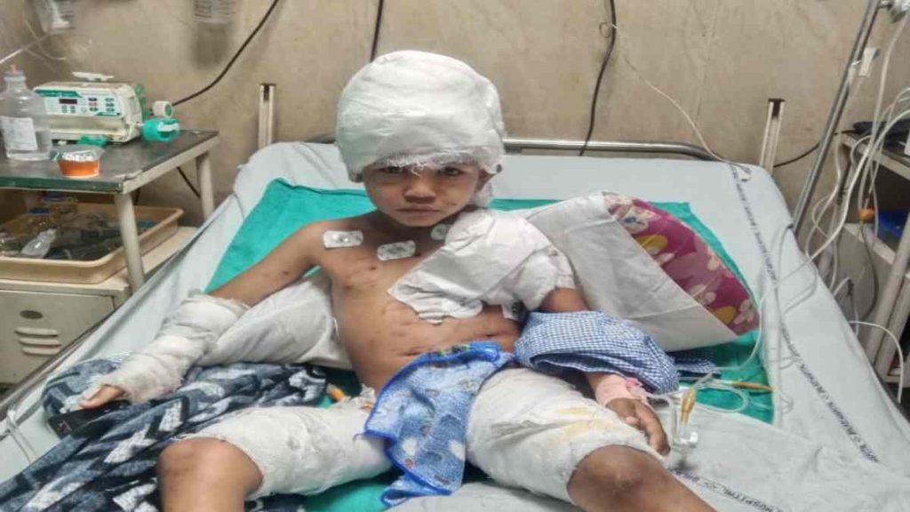 CG : आवारा कुत्तों ने 6 साल के बच्चे पर किया हमला, सिर और पी... - CG Sandesh
